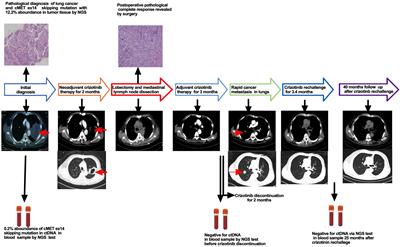 Complete pathological response and negative postoperative ctDNA were not predictive of discontinuation of adjuvant crizotinib therapy in a patient with locally advanced MET ex14 skipping mutation-positive non-small cell lung cancer: a case report